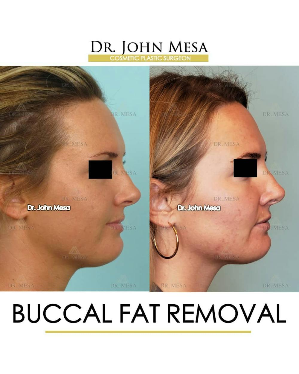 Buccal Fat Pad Removal Before & After Gallery - Patient 157104066 - Image 3