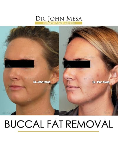 Buccal Fat Pad Removal Before & After Gallery - Patient 157104066 - Image 4