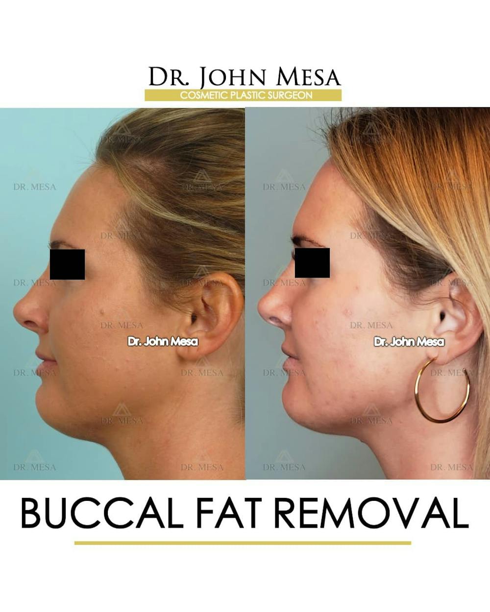 Buccal Fat Pad Removal Before & After Gallery - Patient 157104066 - Image 5