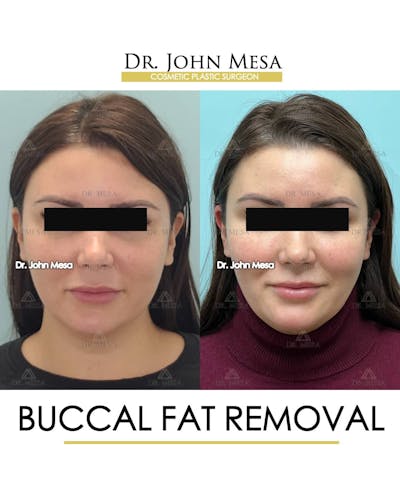 Buccal Fat Pad Removal Before & After Gallery - Patient 157104065 - Image 1