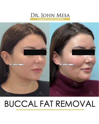 Buccal Fat Pad Removal Before & After Gallery - Patient 157104065 - Image 2