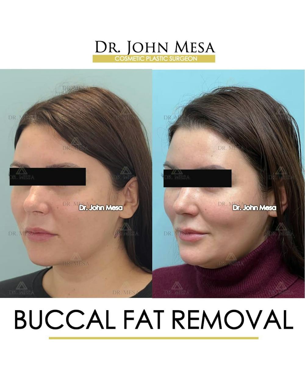 Buccal Fat Pad Removal Before & After Gallery - Patient 157104065 - Image 3