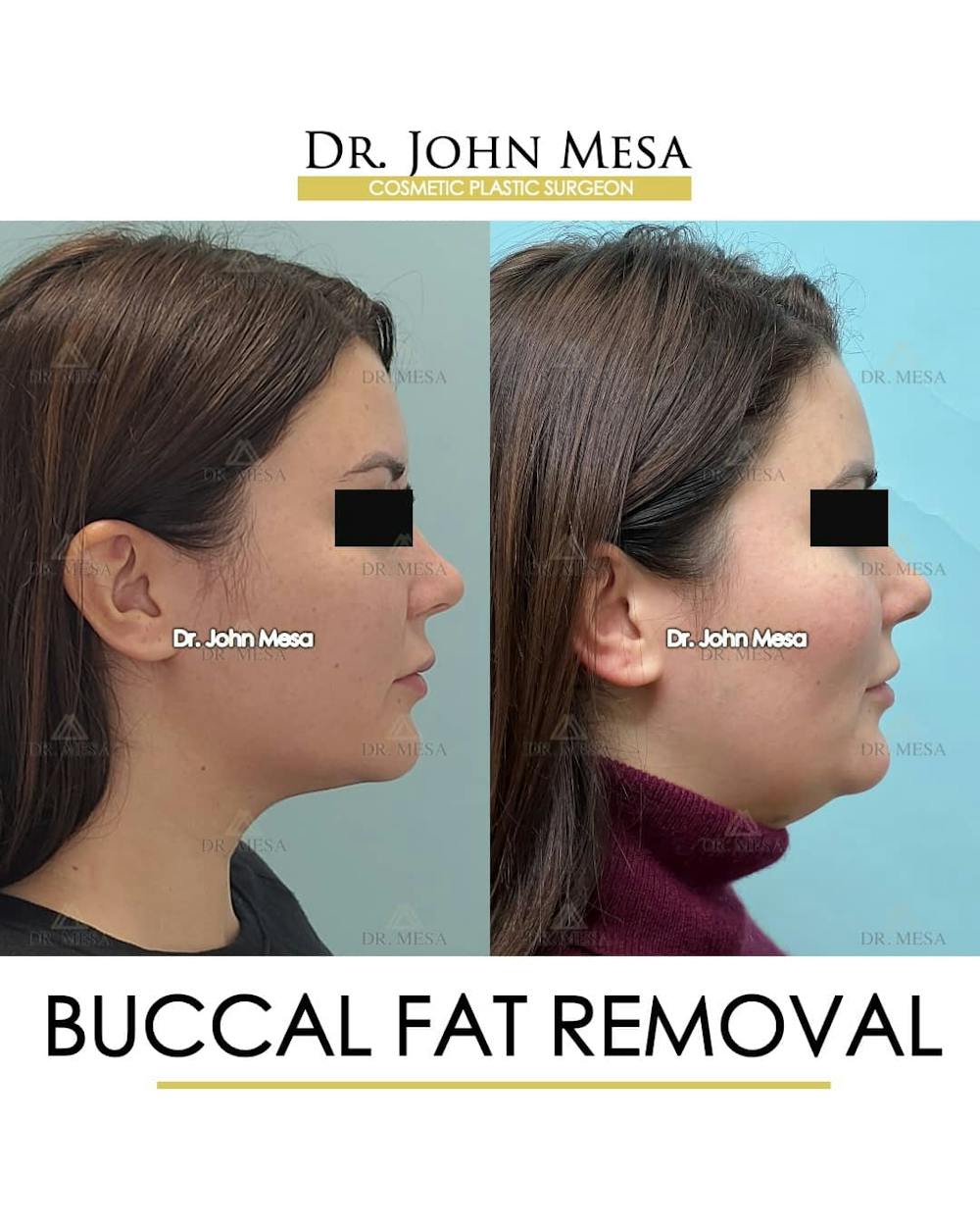 Buccal Fat Pad Removal Before & After Gallery - Patient 157104065 - Image 4