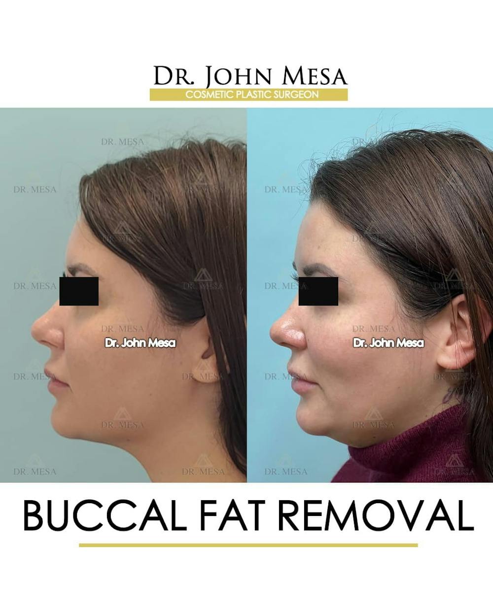 Buccal Fat Pad Removal Before & After Gallery - Patient 157104065 - Image 5