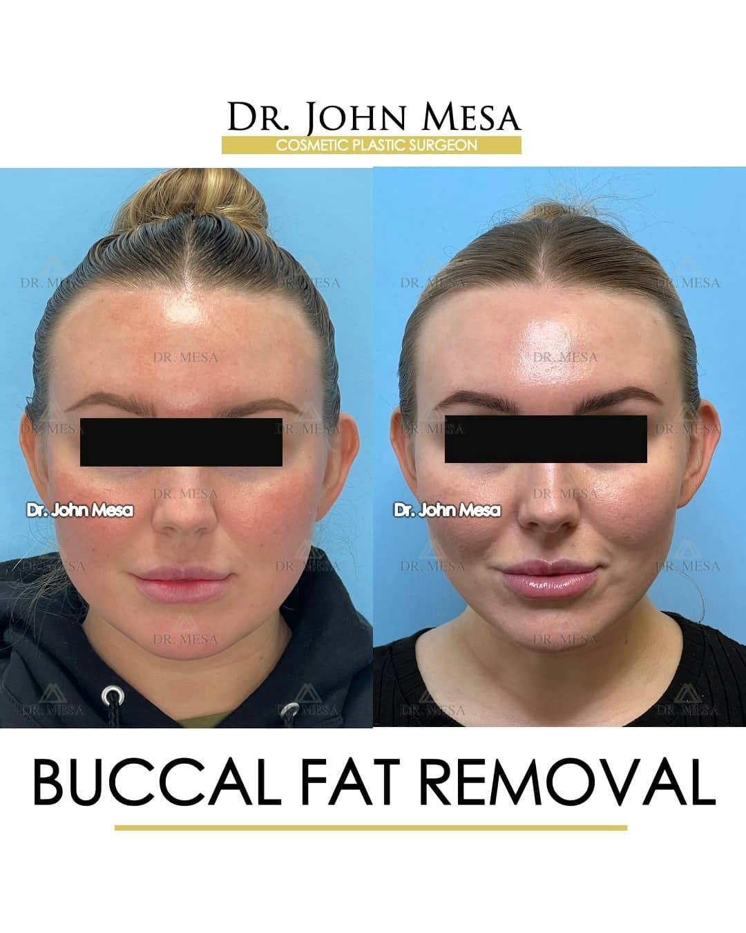 Buccal Fat Pad Removal Before & After Gallery - Patient 157104063 - Image 1