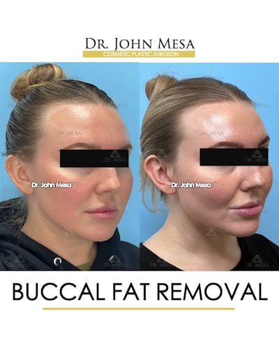 Buccal Fat Pad Removal Before & After Gallery - Patient 157104063 - Image 2