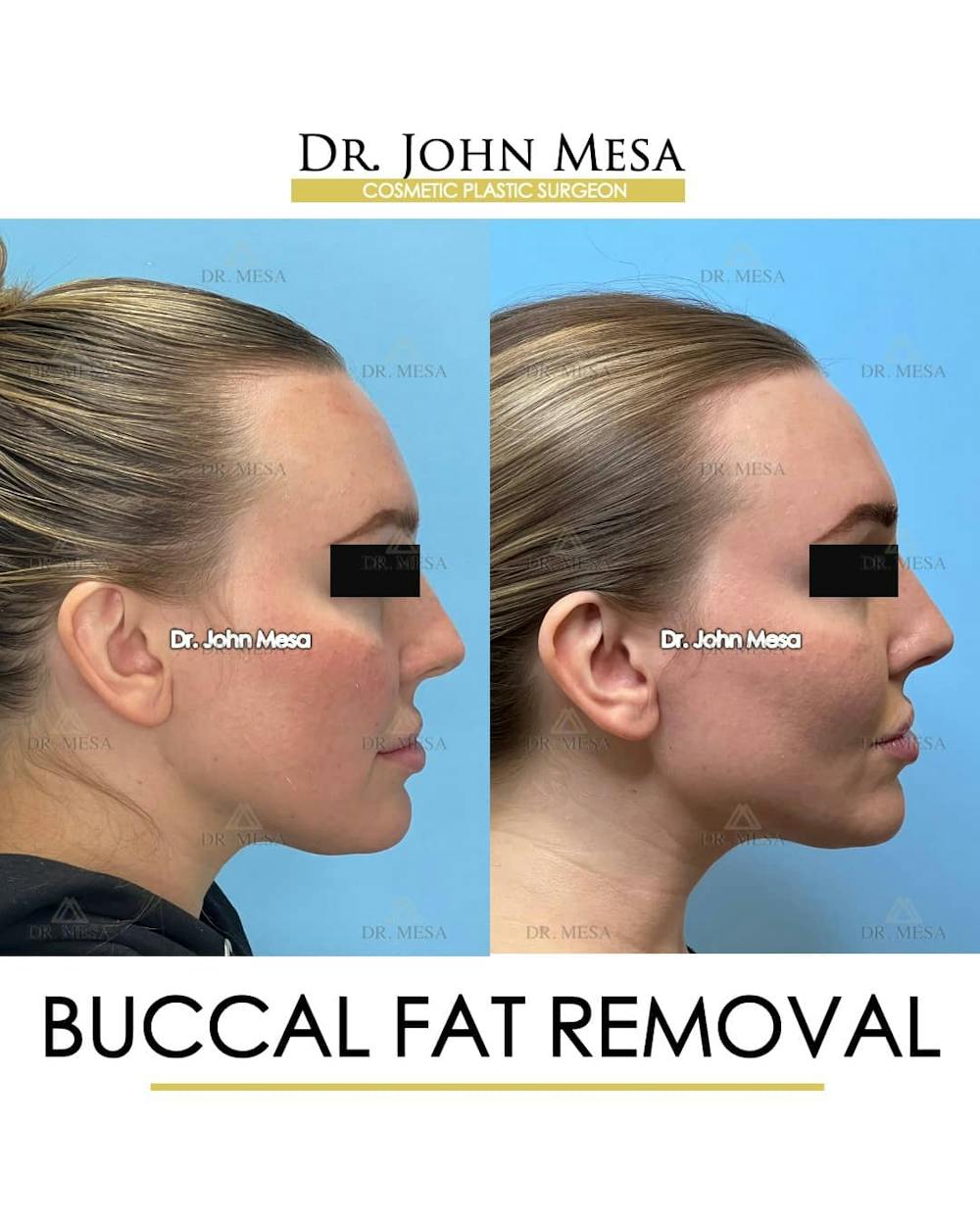 Buccal Fat Pad Removal Before & After Gallery - Patient 157104063 - Image 3