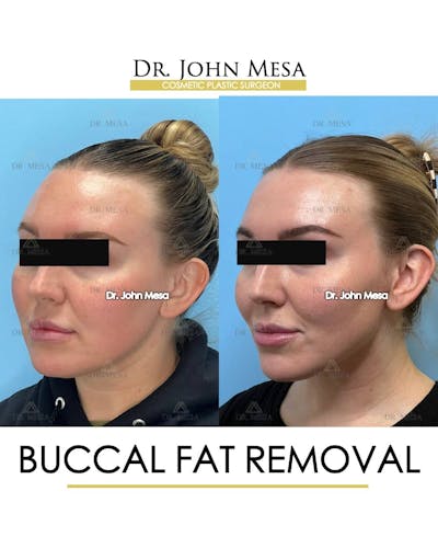 Buccal Fat Pad Removal Before & After Gallery - Patient 157104063 - Image 4