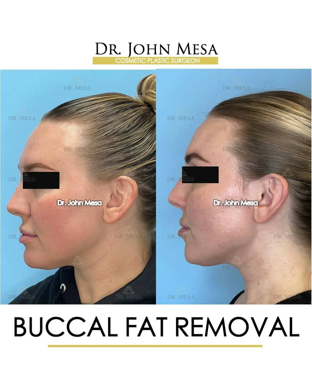 Buccal Fat Pad Removal Before & After Gallery - Patient 157104063 - Image 5