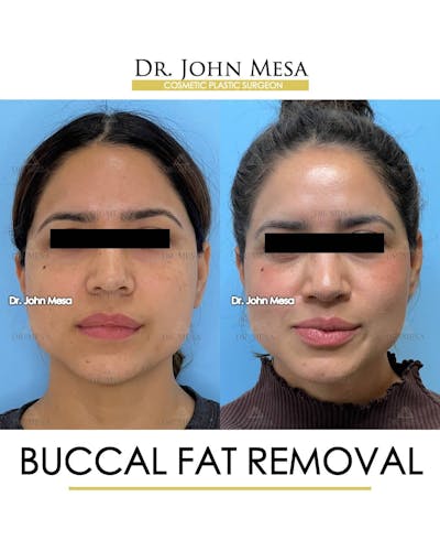 Chin Liposuction Before & After Gallery - Patient 157104123 - Image 2