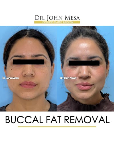 Chin Liposuction Before & After Gallery - Patient 157104123 - Image 1