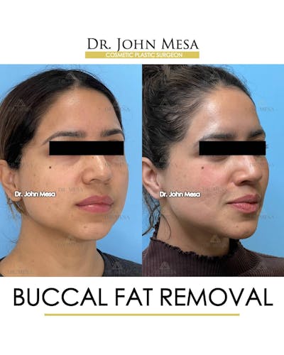 Buccal Fat Pad Removal Before & After Gallery - Patient 157104070 - Image 2