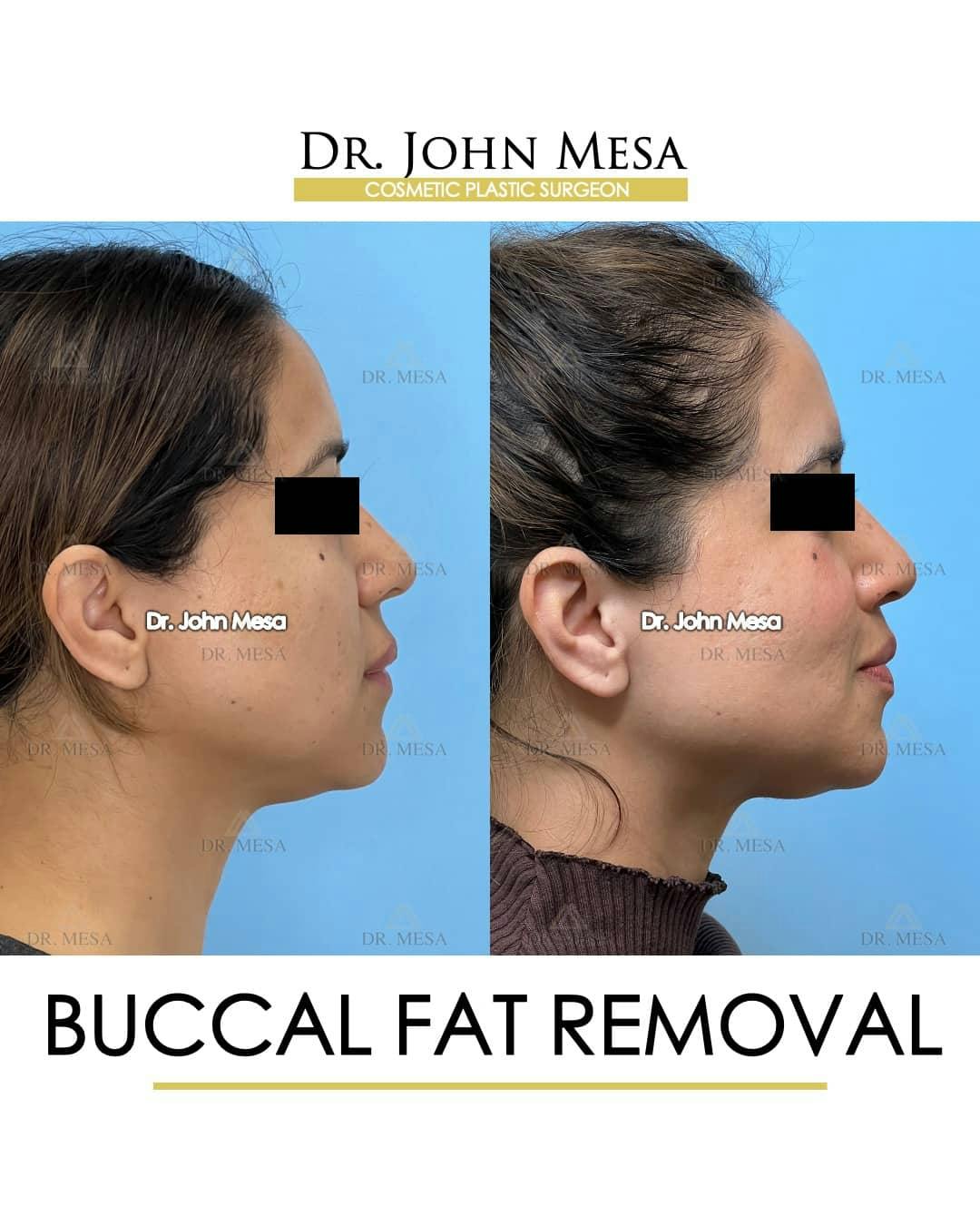 Chin Liposuction Before & After Gallery - Patient 157104123 - Image 1
