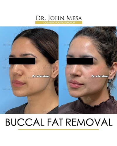 Buccal Fat Pad Removal Before & After Gallery - Patient 157104070 - Image 4