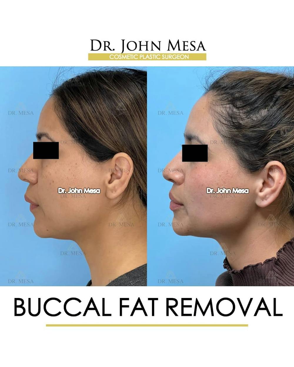Chin Liposuction Before & After Gallery - Patient 157104123 - Image 5