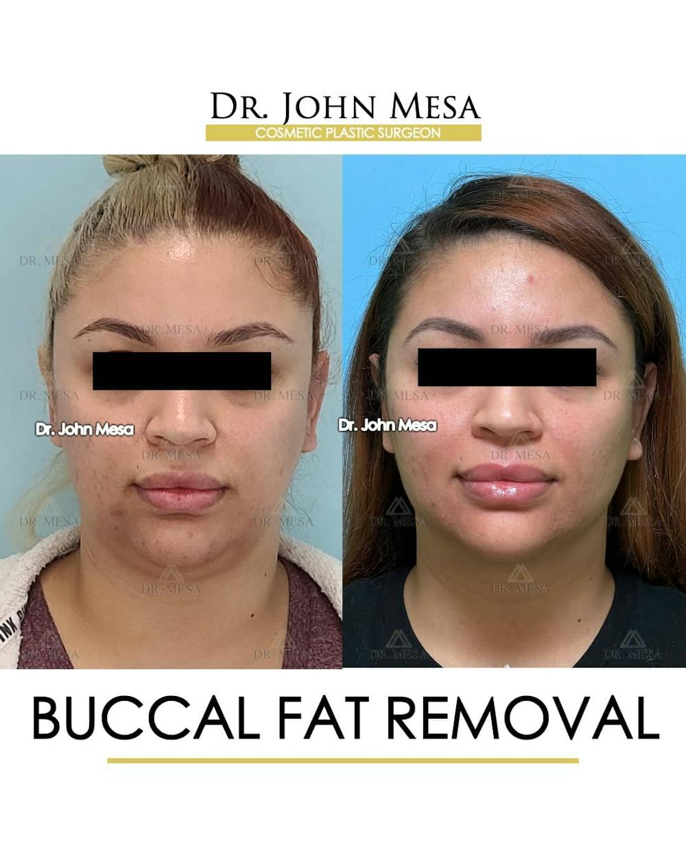 Buccal Fat Pad Removal Before & After Gallery - Patient 157104062 - Image 1