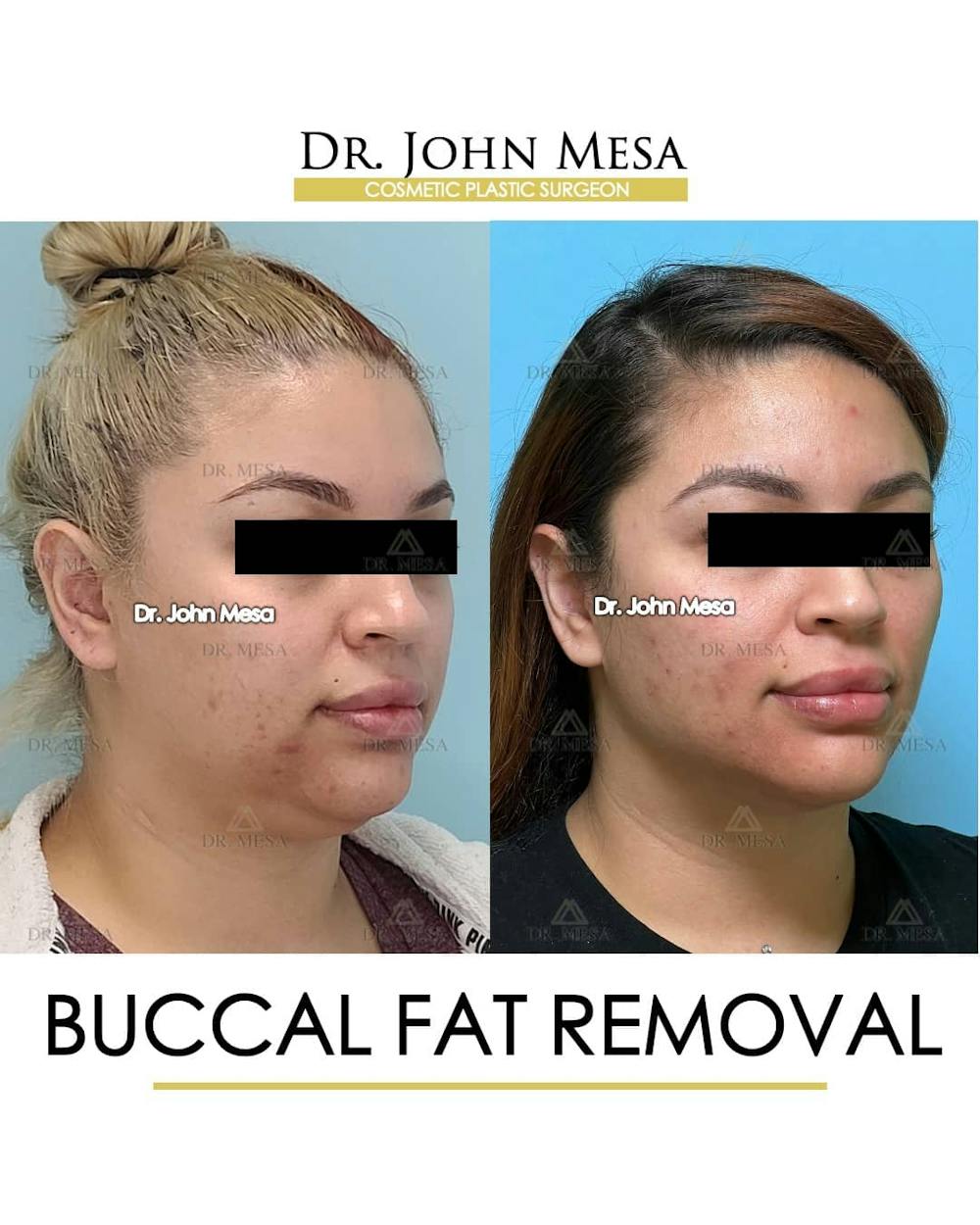 Buccal Fat Pad Removal Before & After Gallery - Patient 157104062 - Image 2