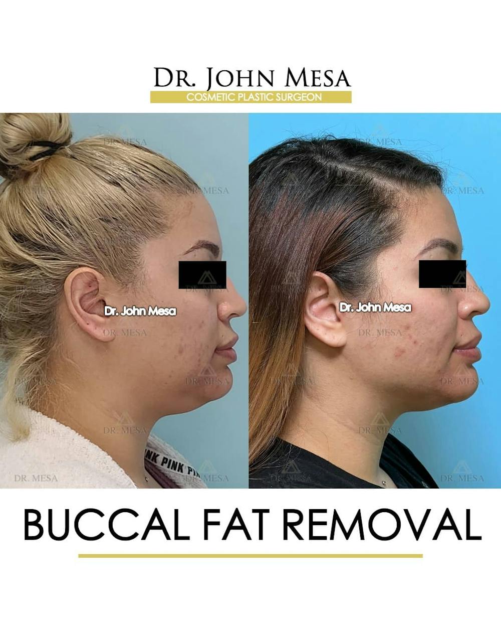 Buccal Fat Pad Removal Before & After Gallery - Patient 157104062 - Image 3