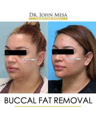 Buccal Fat Pad Removal Before & After Gallery - Patient 157104062 - Image 4