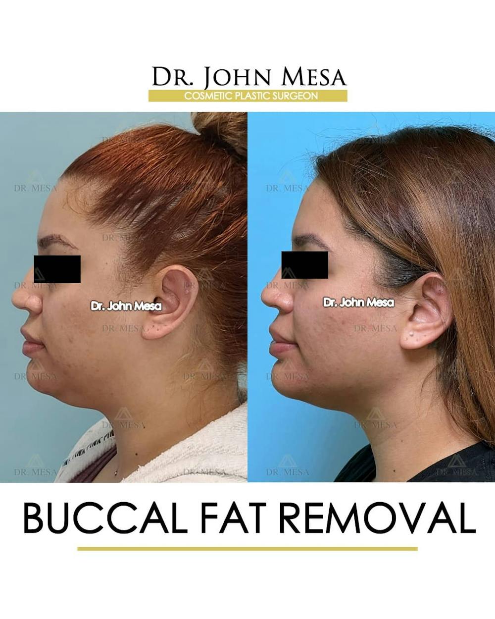Buccal Fat Pad Removal Before & After Gallery - Patient 157104062 - Image 5