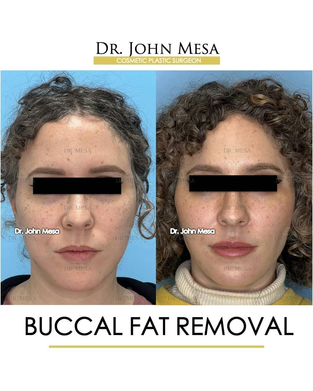Buccal Fat Pad Removal Before & After Gallery - Patient 157104061 - Image 1