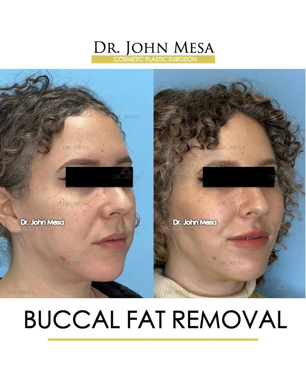 Buccal Fat Pad Removal Before & After Gallery - Patient 157104061 - Image 2