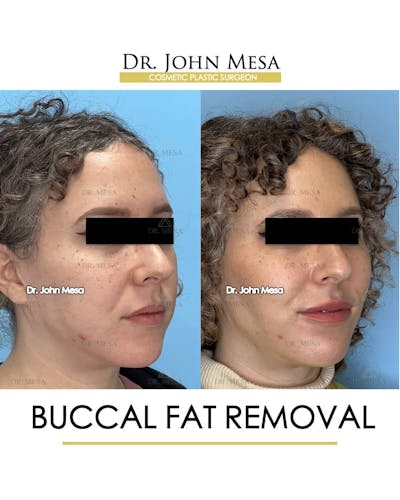 Buccal Fat Pad Removal Before & After Gallery - Patient 157104061 - Image 2