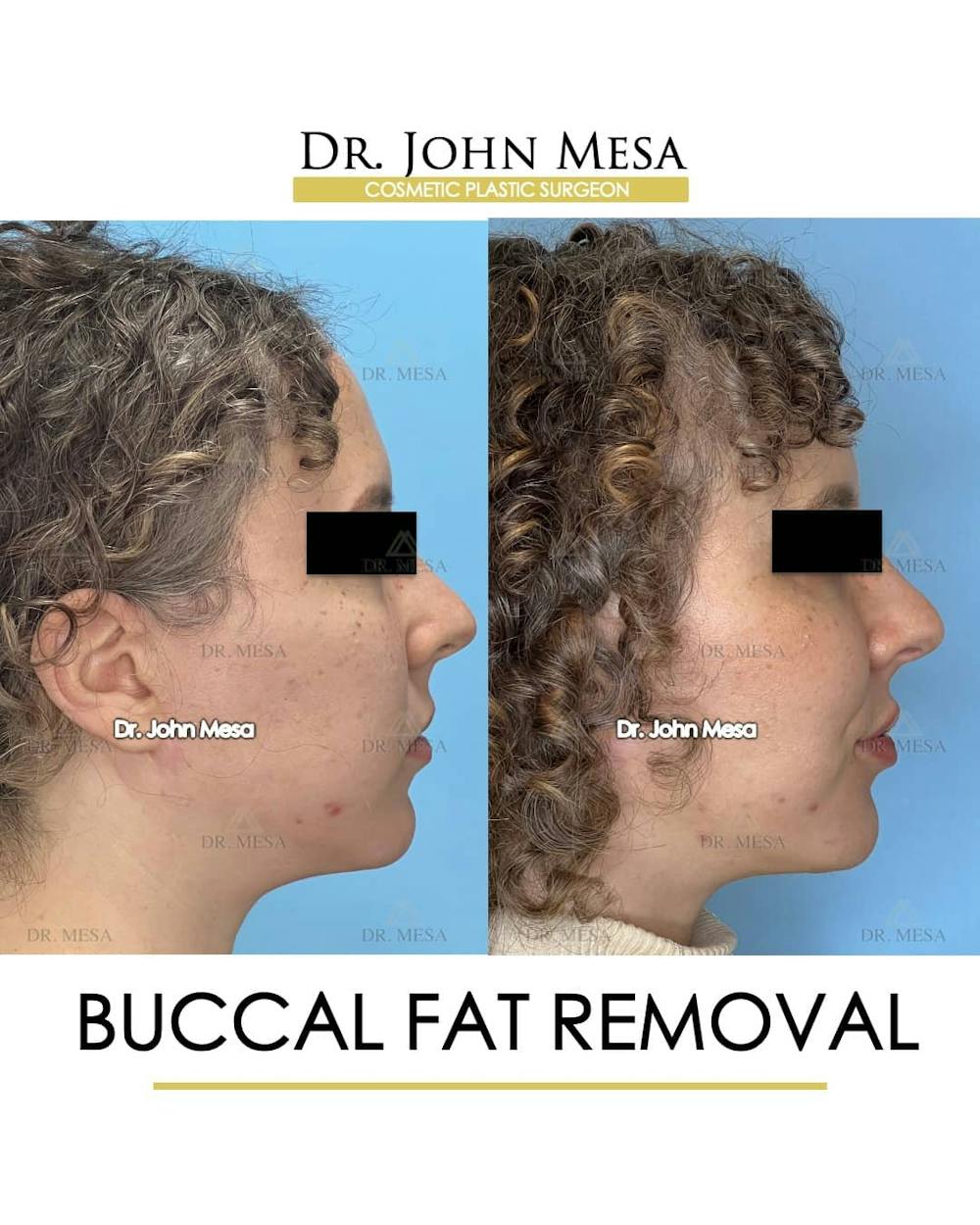 Buccal Fat Pad Removal Before & After Gallery - Patient 157104061 - Image 3