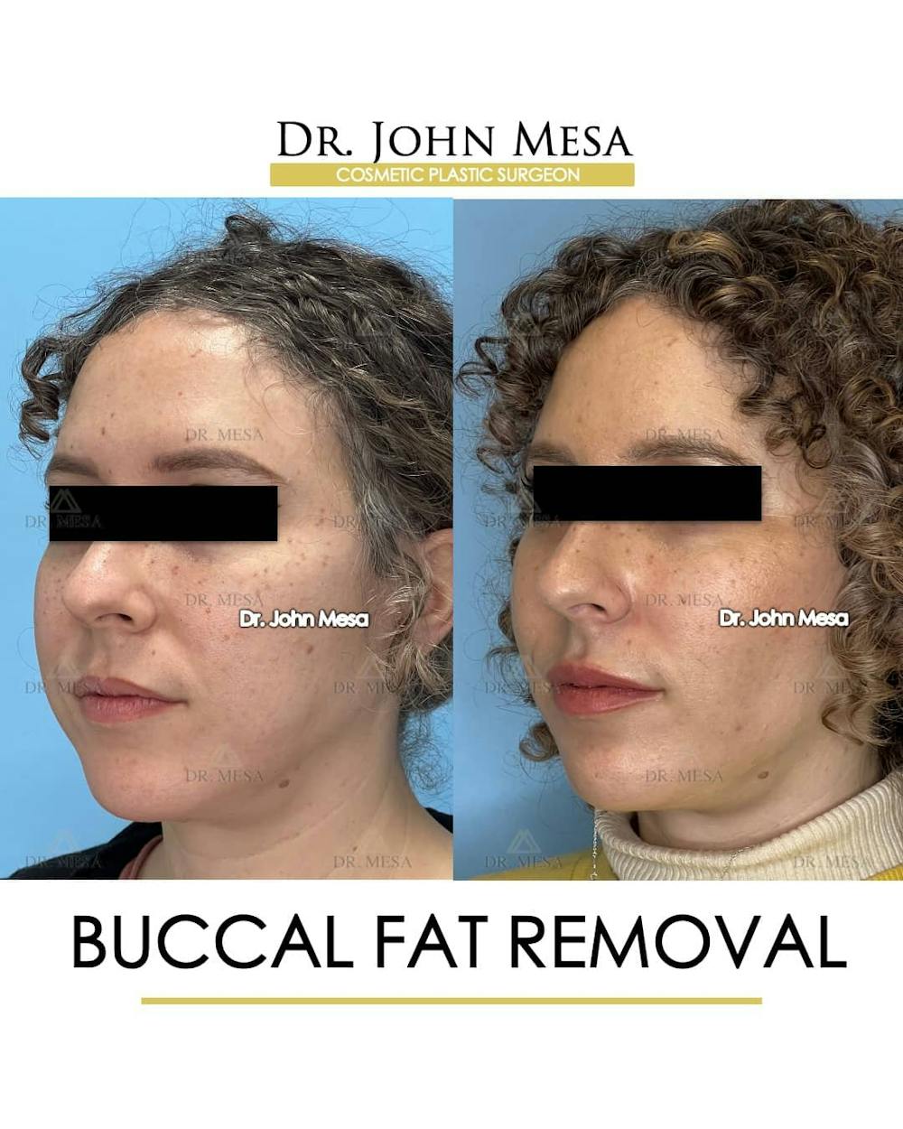 Buccal Fat Pad Removal Before & After Gallery - Patient 157104061 - Image 4