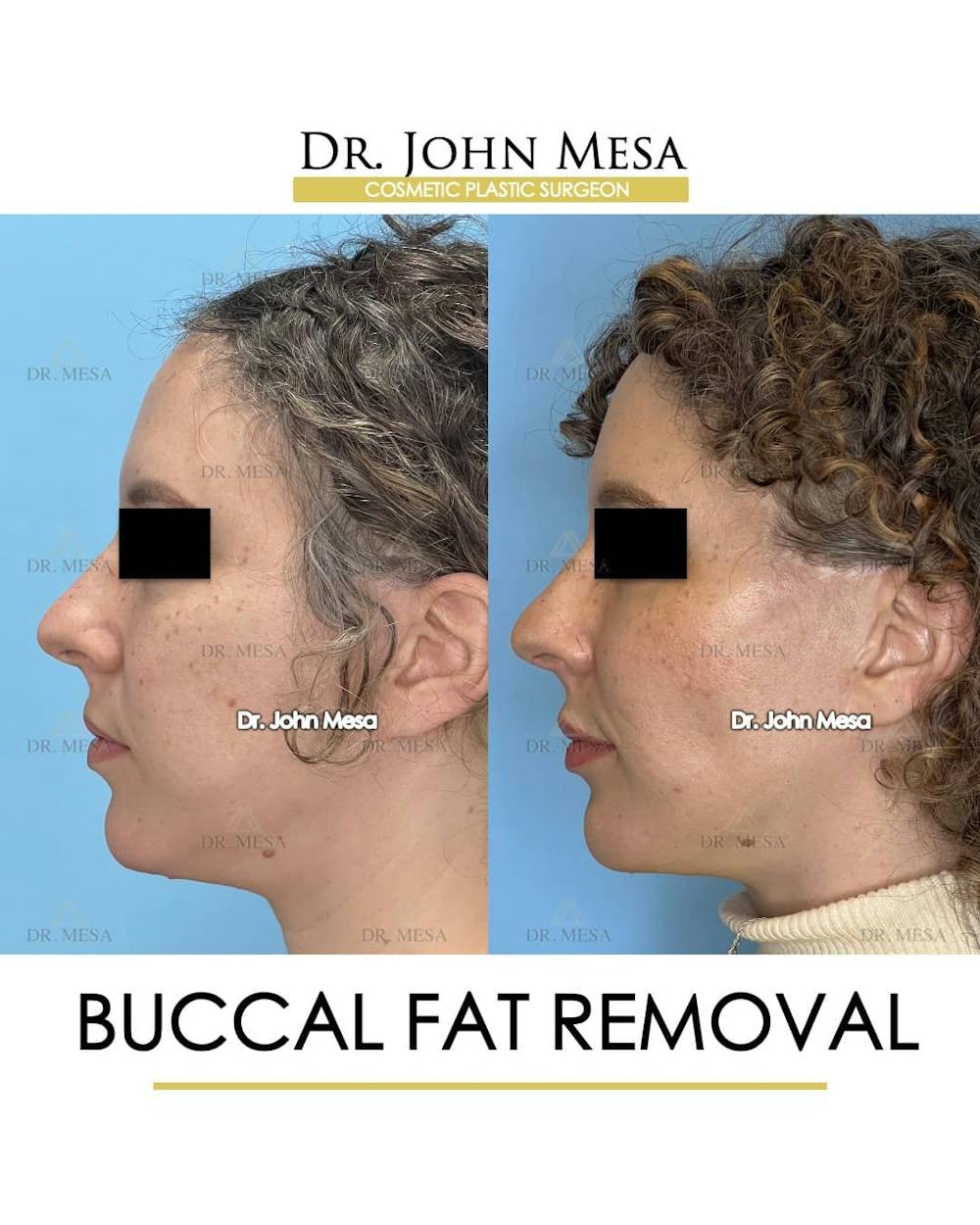 Buccal Fat Pad Removal Before & After Gallery - Patient 157104061 - Image 5