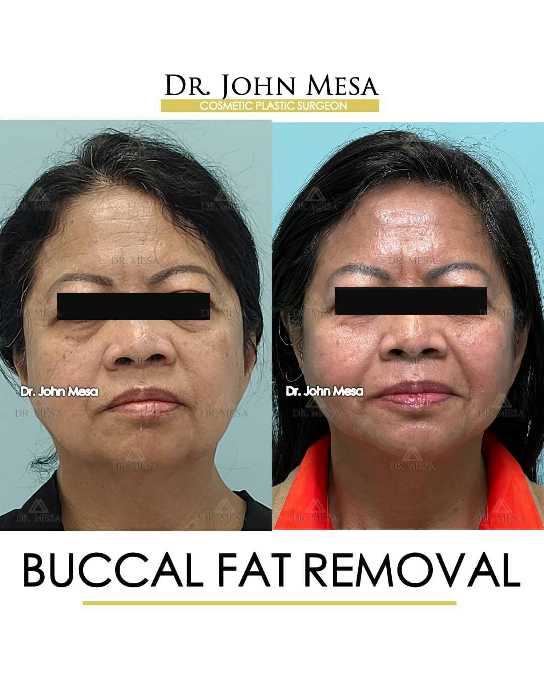 Buccal Fat Pad Removal Before & After Gallery - Patient 157104064 - Image 1