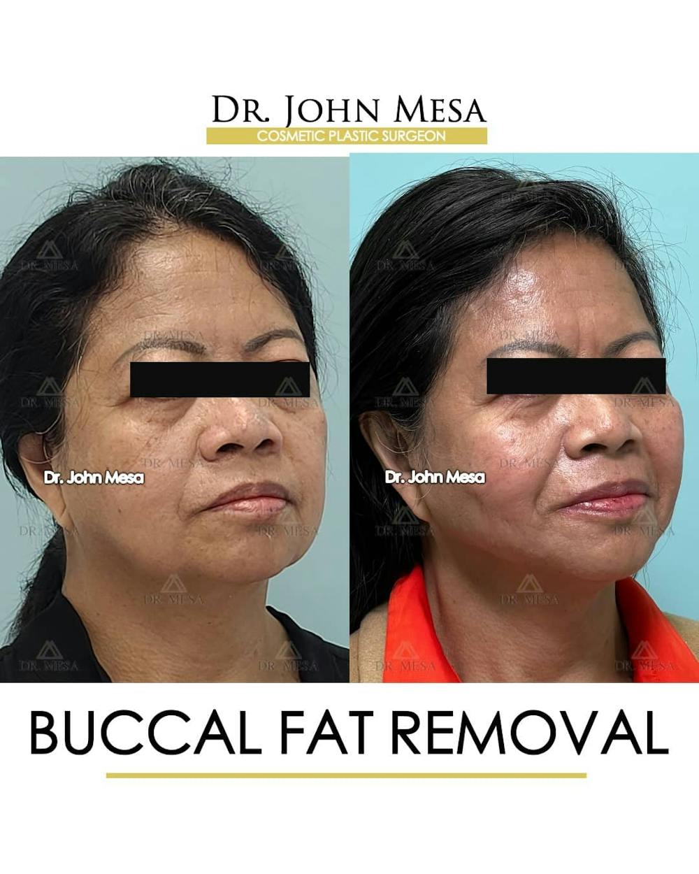 Buccal Fat Pad Removal Before & After Gallery - Patient 157104064 - Image 2