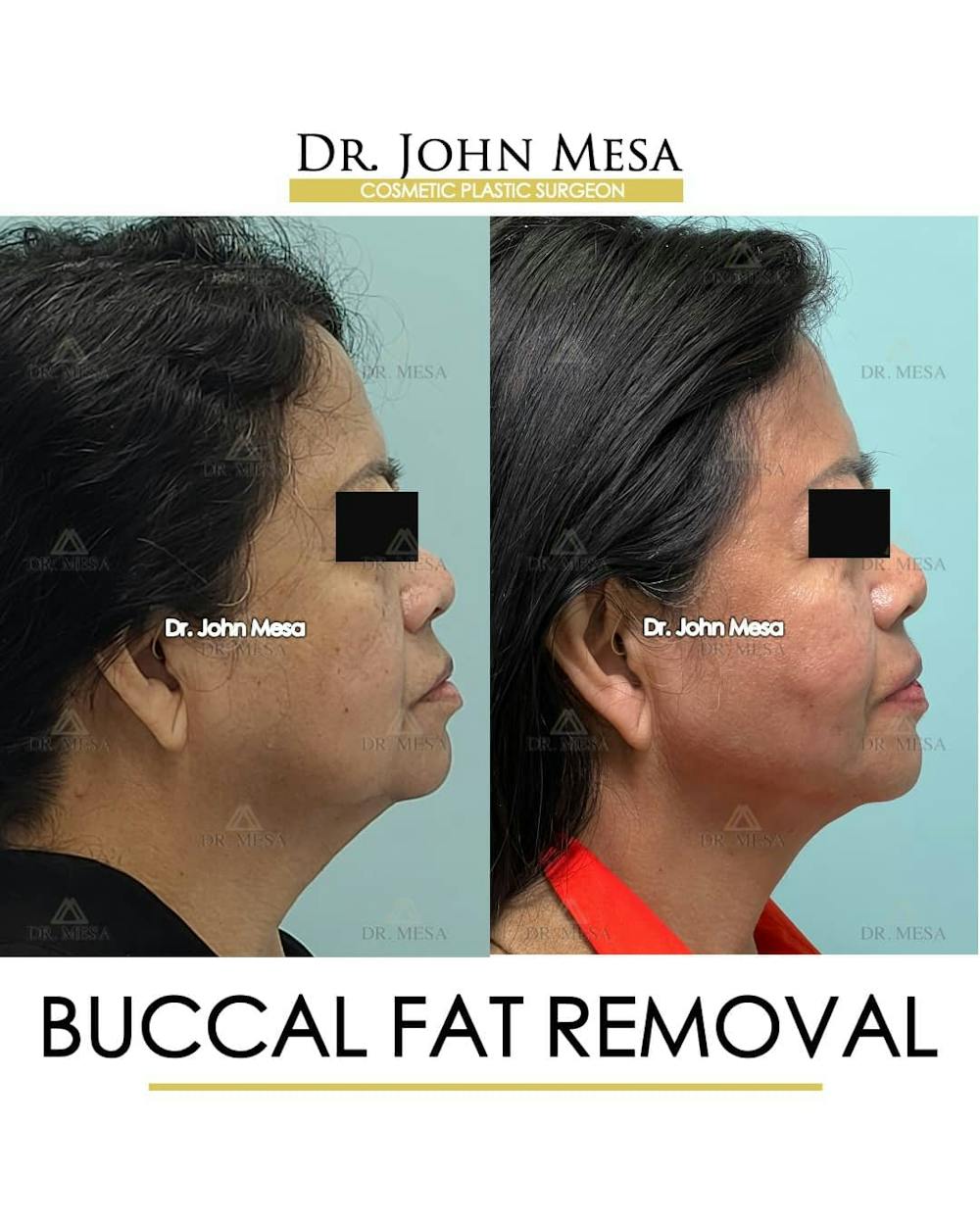 Buccal Fat Pad Removal Before & After Gallery - Patient 157104064 - Image 3