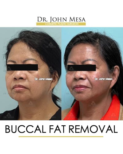 Buccal Fat Pad Removal Before & After Gallery - Patient 157104064 - Image 4