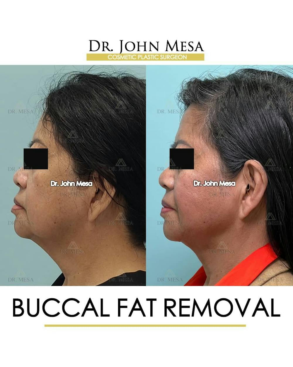 Buccal Fat Pad Removal Before & After Gallery - Patient 157104064 - Image 5