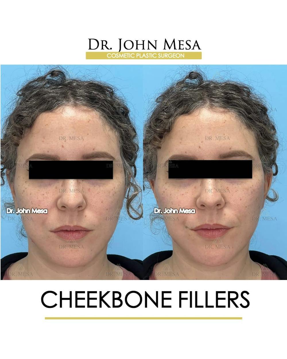 Cheekbone Filler Before & After Gallery - Patient 157104079 - Image 1
