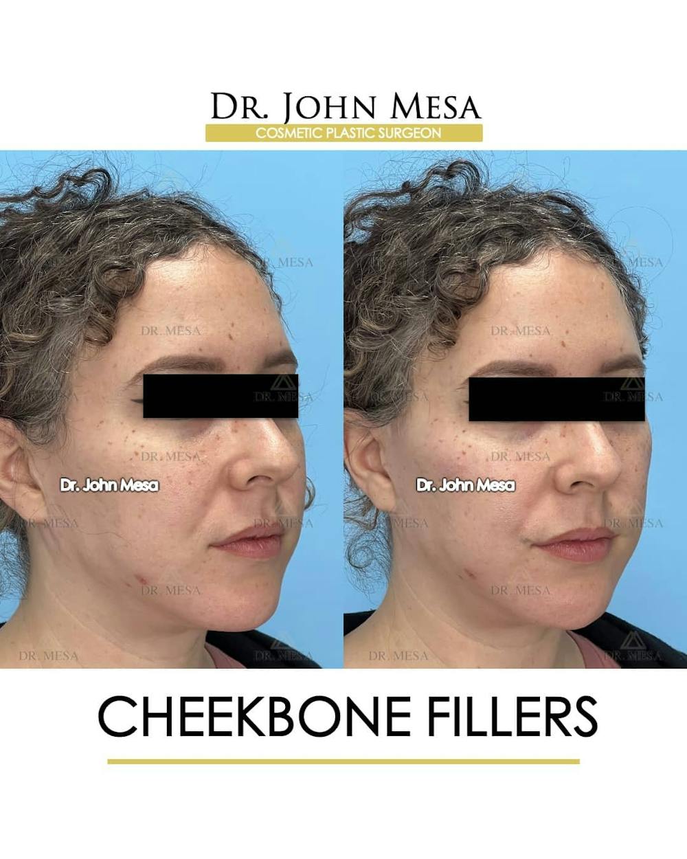 Cheekbone Filler Before & After Gallery - Patient 157104079 - Image 2