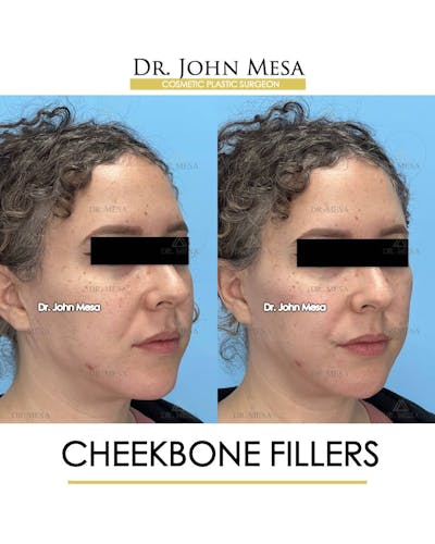 Cheekbone Filler Before & After Gallery - Patient 157104079 - Image 2