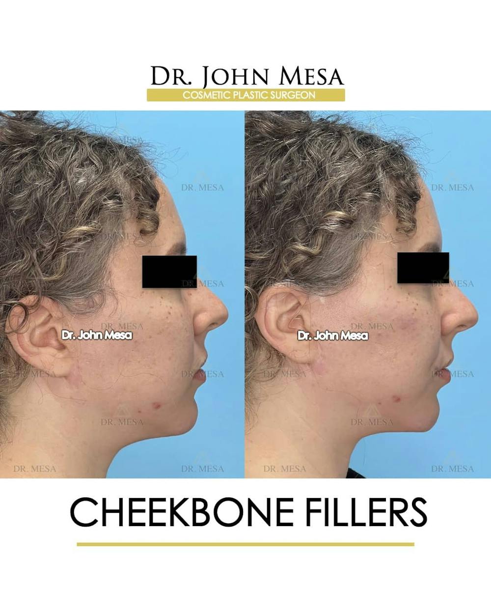 Cheekbone Filler Before & After Gallery - Patient 157104079 - Image 3