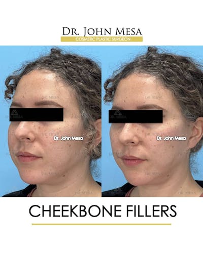 Cheekbone Filler Before & After Gallery - Patient 157104079 - Image 4