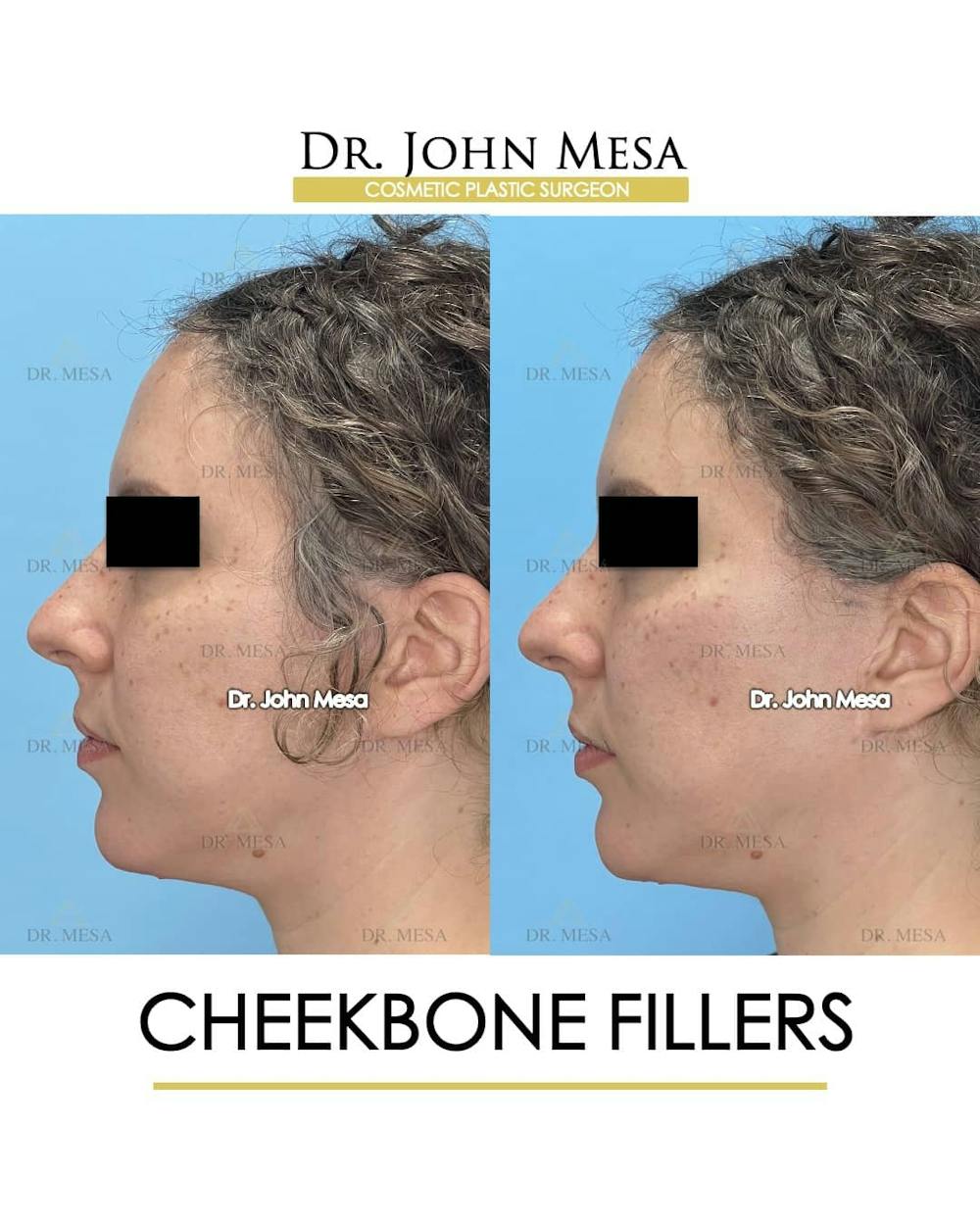 Cheekbone Filler Before & After Gallery - Patient 157104079 - Image 5