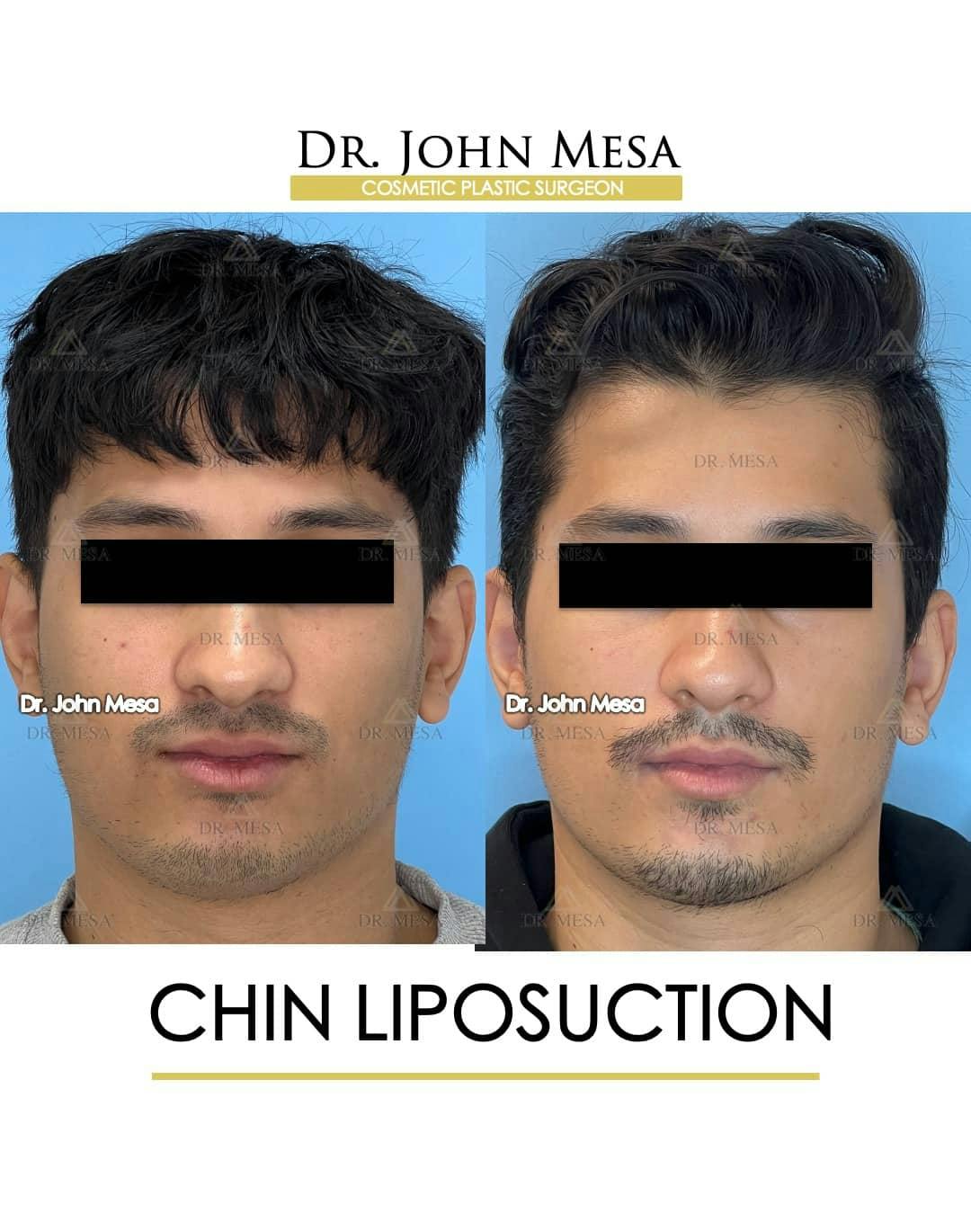 Chin Liposuction Before & After Gallery - Patient 157104088 - Image 1