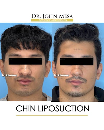 Chin Liposuction Before & After Gallery - Patient 157104088 - Image 2