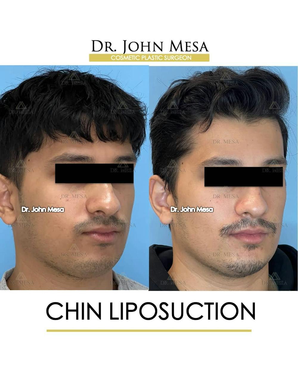 Chin Liposuction Before & After Gallery - Patient 157104088 - Image 3