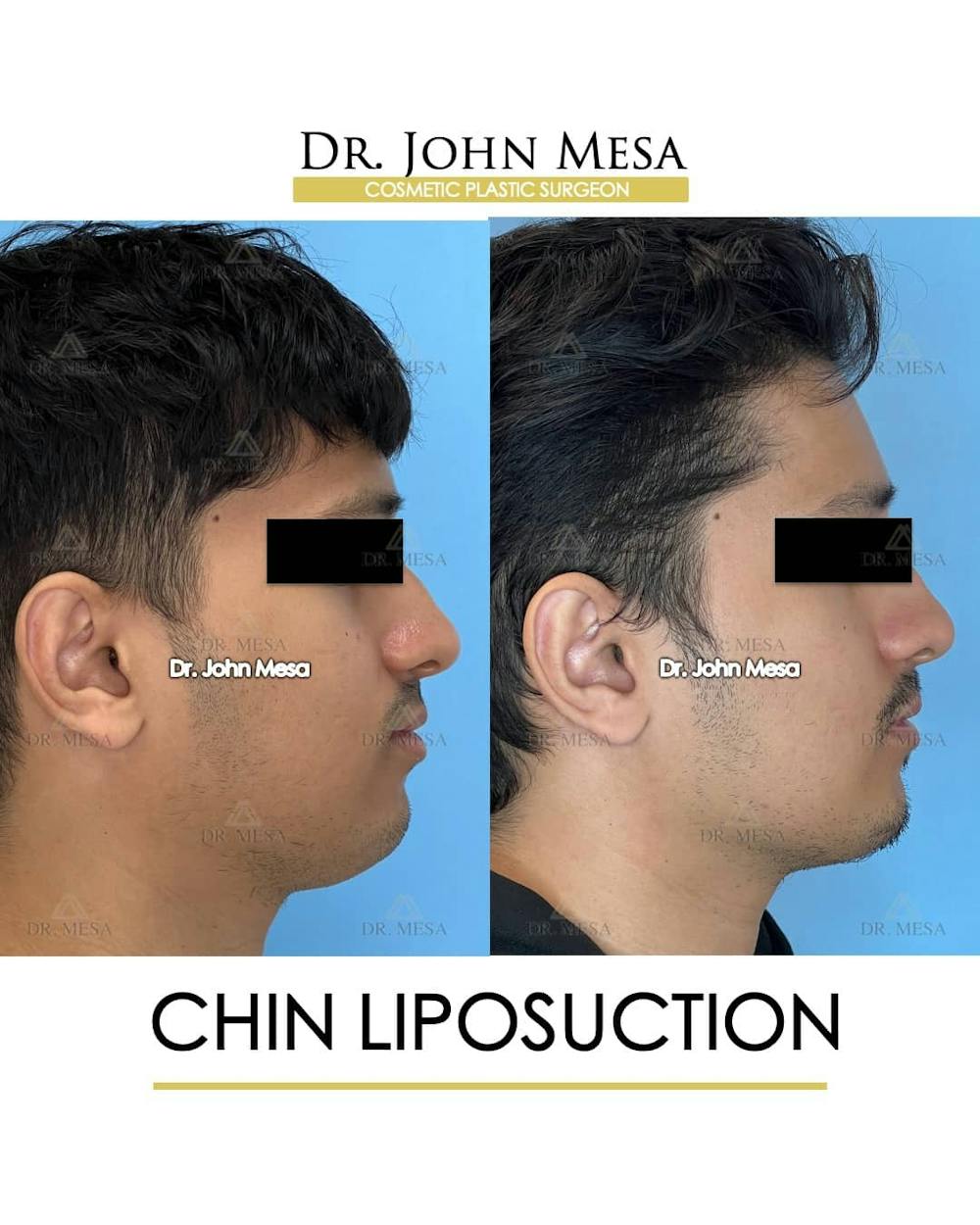 Chin Liposuction Before & After Gallery - Patient 157104088 - Image 3
