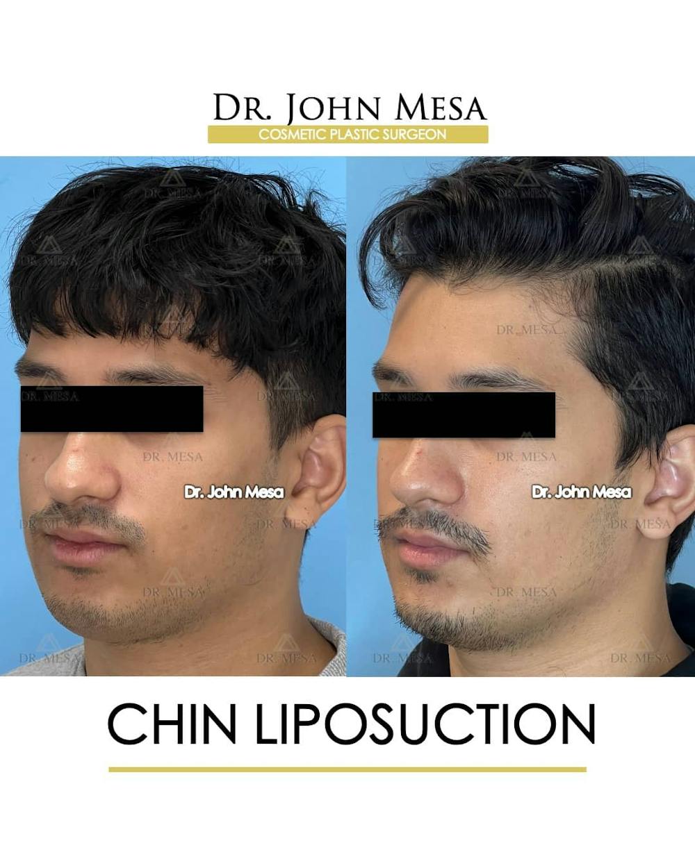 Chin Liposuction Before & After Gallery - Patient 157104088 - Image 4