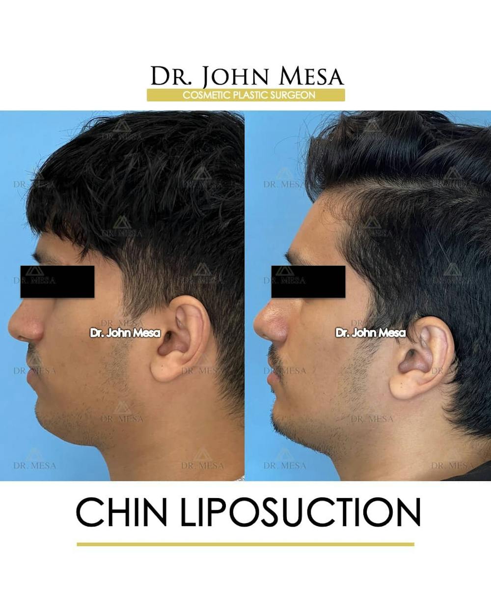 Chin Liposuction Before & After Gallery - Patient 157104088 - Image 5