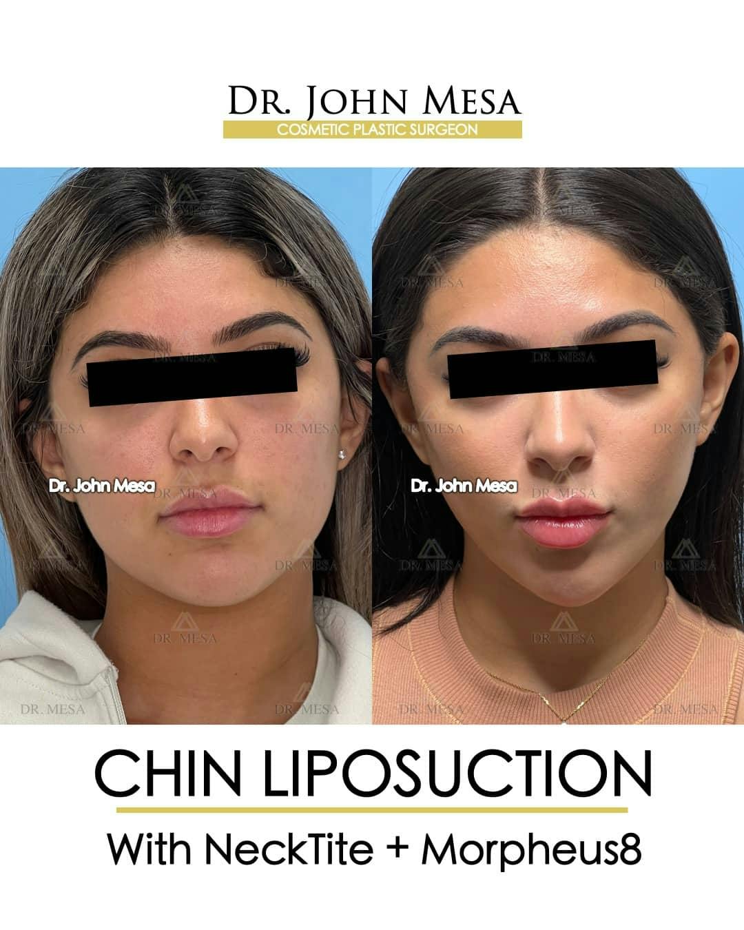 Chin Liposuction Before & After Gallery - Patient 157104125 - Image 1