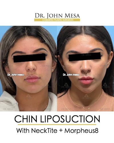 Chin Liposuction Before & After Gallery - Patient 157104125 - Image 2