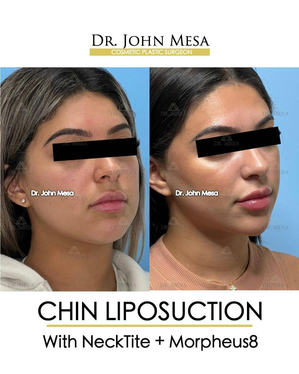 Chin Liposuction Before & After Gallery - Patient 157104125 - Image 3
